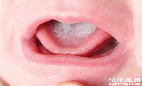 嬰兒舌苔厚白是怎么回事 嬰兒舌苔厚白怎么去除